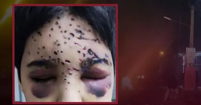 تاهیر مەلەکشایی منداڵی ١٢ ساڵەی کورد کە لە بەشی ڕووخسارییەوە بە چەکی ساچمەیی بە سەختی بریندار دەبێت